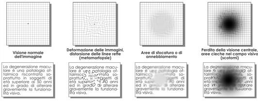 Strumento di prevenzione per la degenerazione maculare è la griglia di Amsler, che consente di vedere subito distorsioni, sfocature o aree cieche nel campo visivo